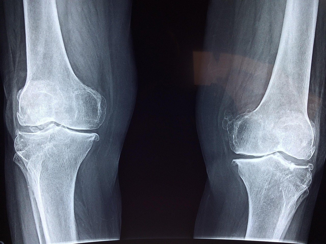knee, x-ray, medical, anatomy, skeleton, bone, orthopedic, joint, health, injury, patient, cartilage, treatment, hospital, therapist, illness, disease, blue health, blue hospital, blue medical, knee, knee, knee, x-ray, bone, bone, bone, bone, bone, joint, joint, injury, injury